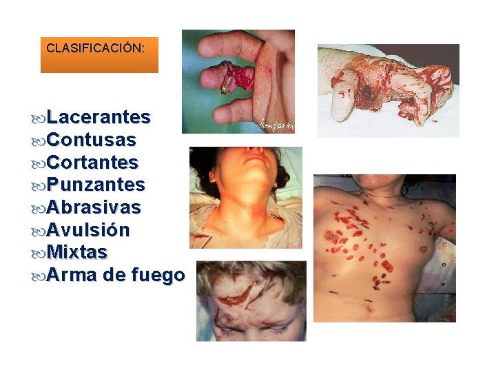 CLASIFICACIÓN: Lacerantes Contusas Cortantes Punzantes Abrasivas Avulsión Mixtas Arma de fuego 