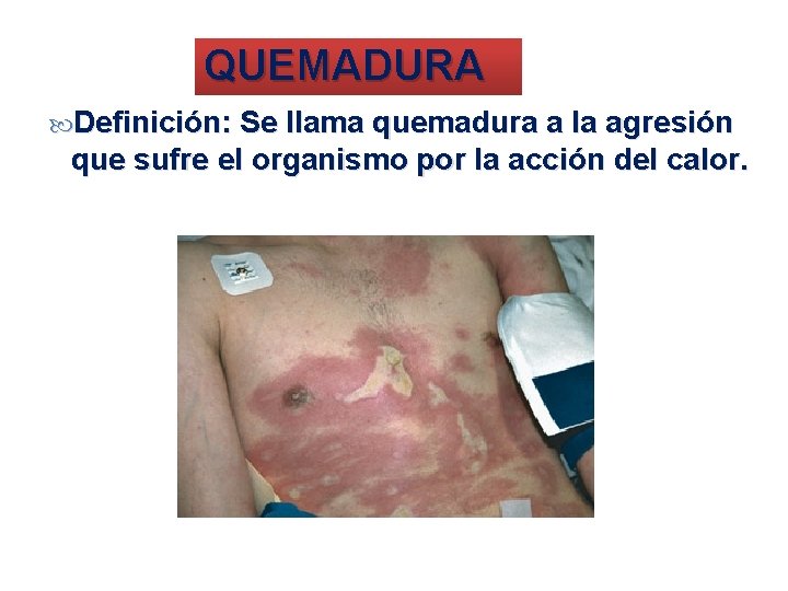 QUEMADURA Definición: Se llama quemadura a la agresión que sufre el organismo por la
