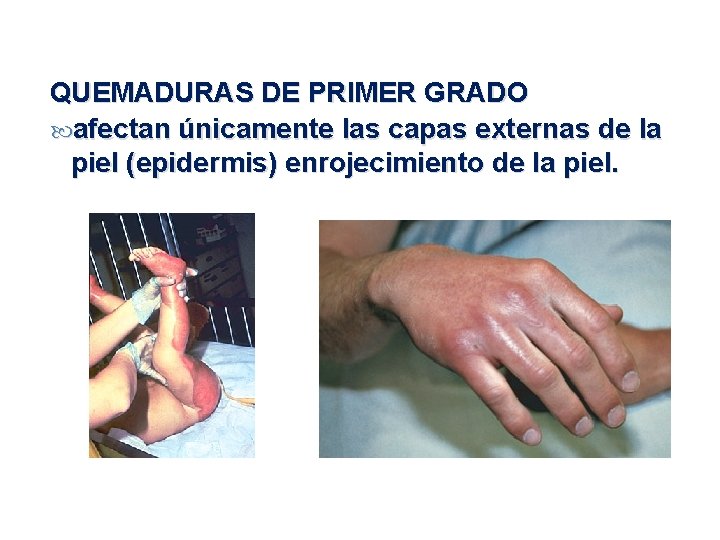 QUEMADURAS DE PRIMER GRADO afectan únicamente las capas externas de la piel (epidermis) enrojecimiento