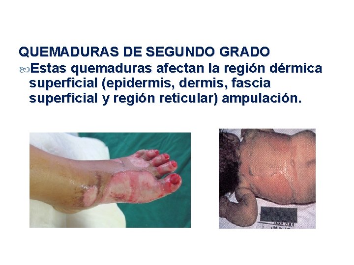 QUEMADURAS DE SEGUNDO GRADO Estas quemaduras afectan la región dérmica superficial (epidermis, fascia superficial