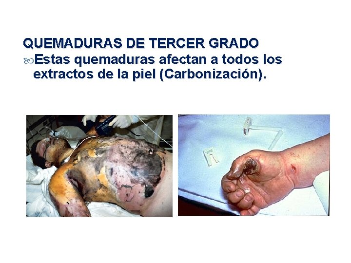 QUEMADURAS DE TERCER GRADO Estas quemaduras afectan a todos los extractos de la piel