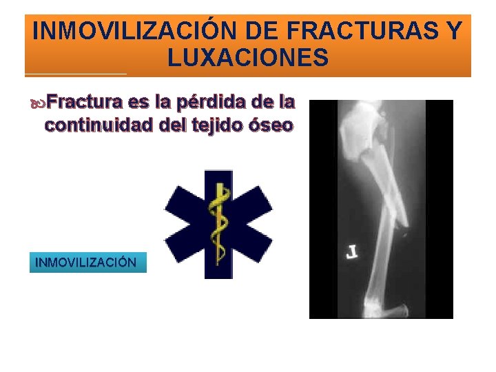 INMOVILIZACIÓN DE FRACTURAS Y LUXACIONES Fractura es la pérdida de la continuidad del tejido