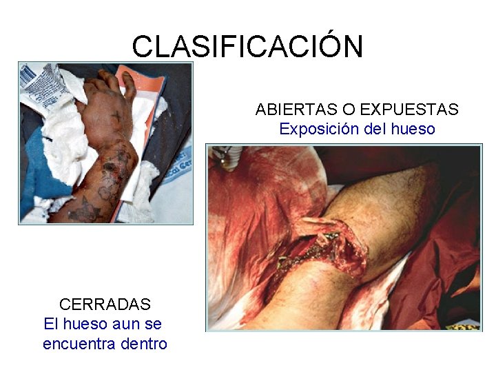 CLASIFICACIÓN ABIERTAS O EXPUESTAS Exposición del hueso CERRADAS El hueso aun se encuentra dentro