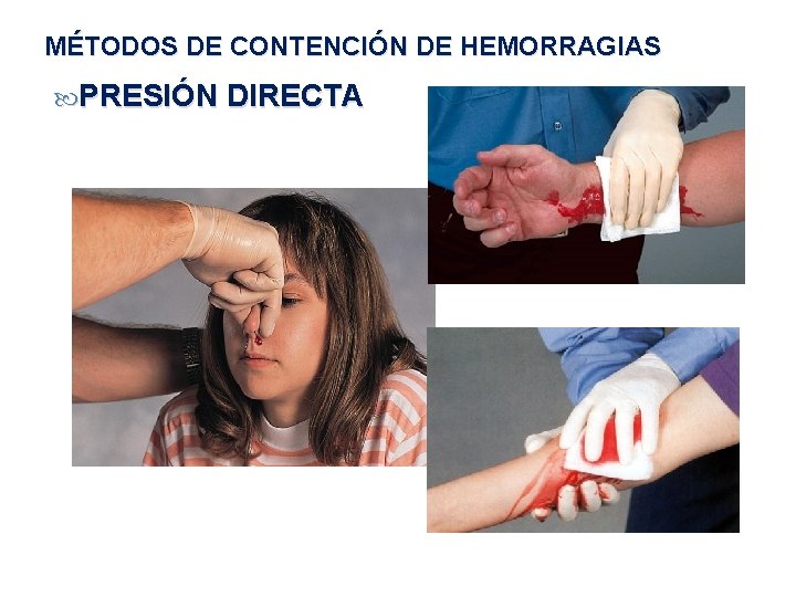 MÉTODOS DE CONTENCIÓN DE HEMORRAGIAS PRESIÓN DIRECTA 