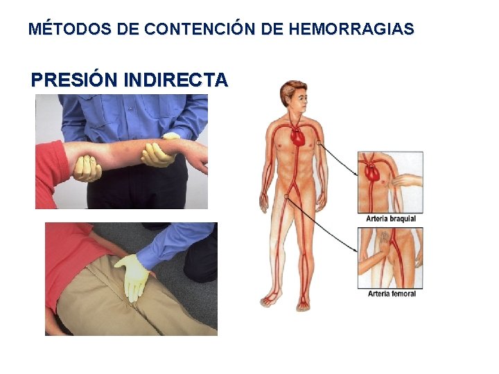 MÉTODOS DE CONTENCIÓN DE HEMORRAGIAS PRESIÓN INDIRECTA 
