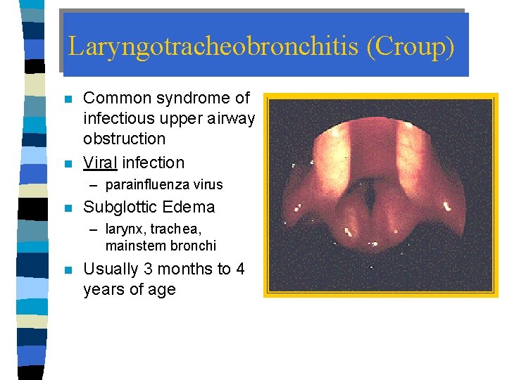 Laryngotracheobronchitis (Croup) n n Common syndrome of infectious upper airway obstruction Viral infection –