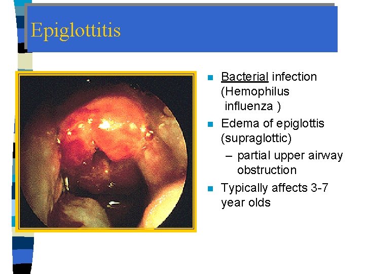 Epiglottitis n n n Bacterial infection (Hemophilus influenza ) Edema of epiglottis (supraglottic) –