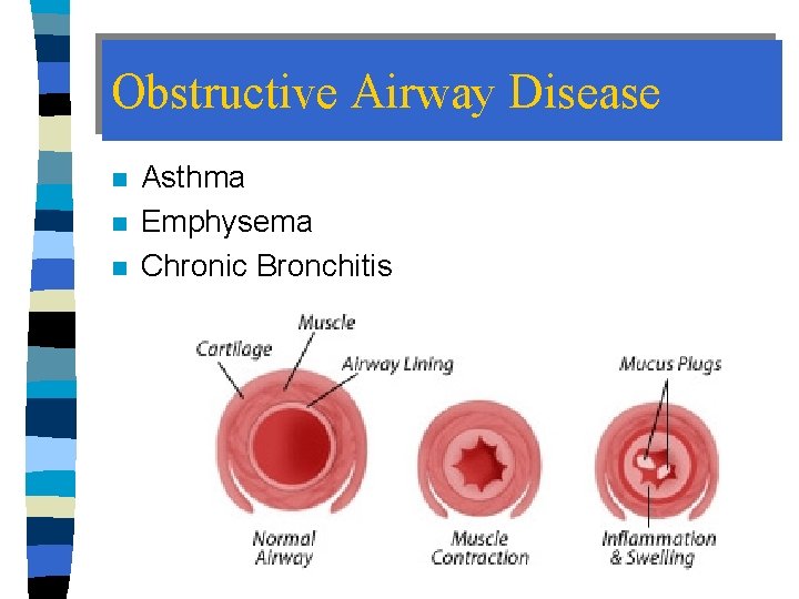 Obstructive Airway Disease n n n Asthma Emphysema Chronic Bronchitis 