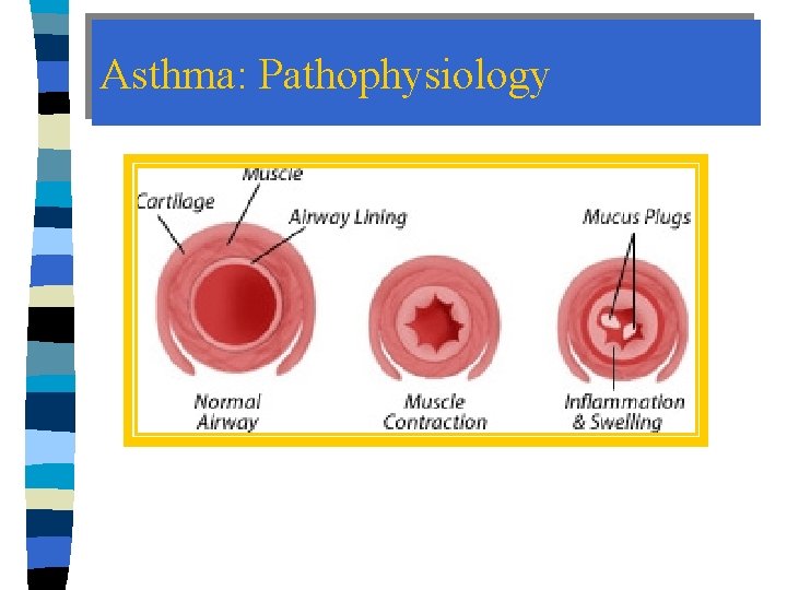 Asthma: Pathophysiology 