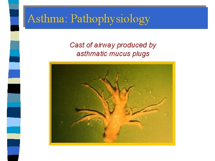 Asthma: Pathophysiology Cast of airway produced by asthmatic mucus plugs 