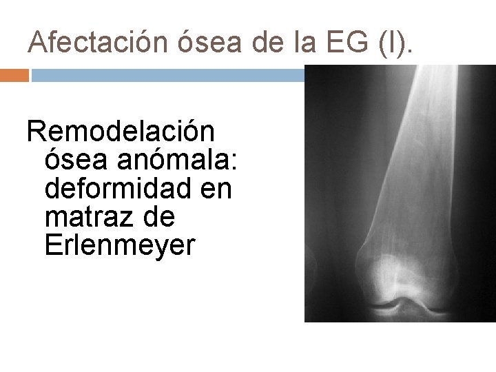 Afectación ósea de la EG (I). Remodelación ósea anómala: deformidad en matraz de Erlenmeyer