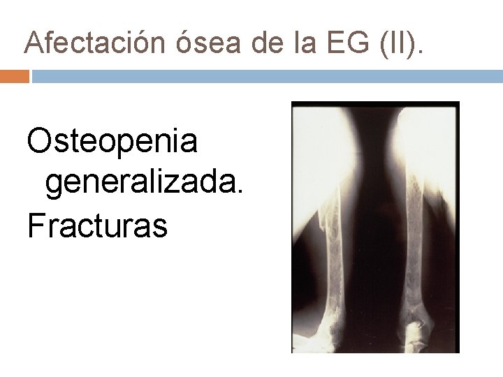 Afectación ósea de la EG (II). Osteopenia generalizada. Fracturas 