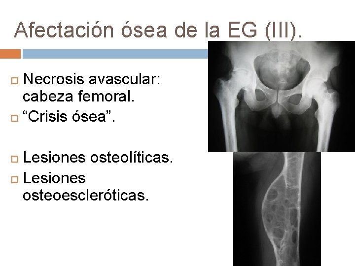 Afectación ósea de la EG (III). Necrosis avascular: cabeza femoral. “Crisis ósea”. Lesiones osteolíticas.