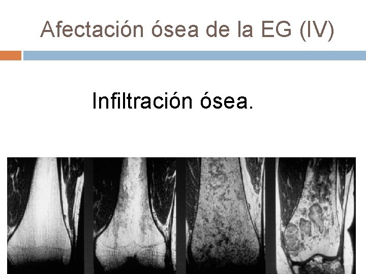 Afectación ósea de la EG (IV) Infiltración ósea. 