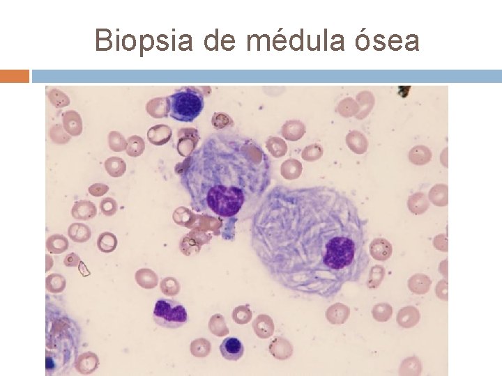 Biopsia de médula ósea ü ¿leemos de nuevo la anamnesis? 