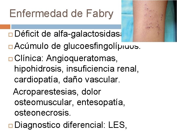 Enfermedad de Fabry Déficit de alfa-galactosidasa. Acúmulo de glucoesfingolípidos. Clínica: Angioqueratomas, hipohidrosis, insuficiencia renal,