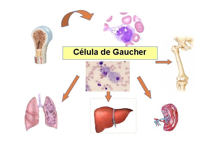 Célula de Gaucher 
