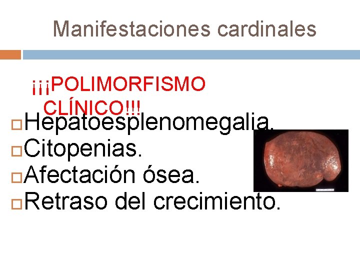 Manifestaciones cardinales ¡¡¡POLIMORFISMO CLÍNICO!!! Hepatoesplenomegalia. Citopenias. Afectación ósea. Retraso del crecimiento. 