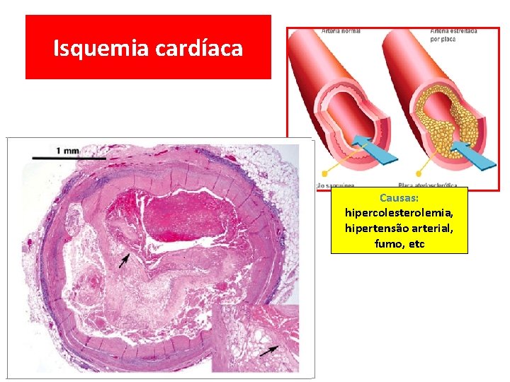 Isquemia cardíaca Causas: hipercolesterolemia, hipertensão arterial, fumo, etc 