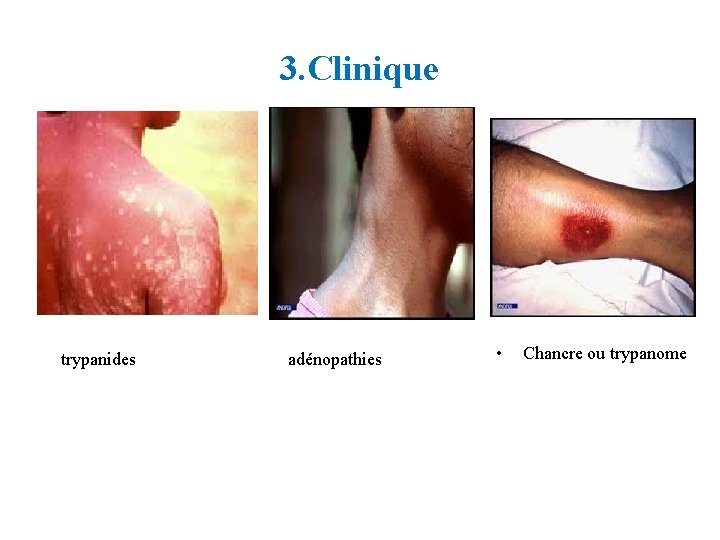 3. Clinique trypanides adénopathies • Chancre ou trypanome 