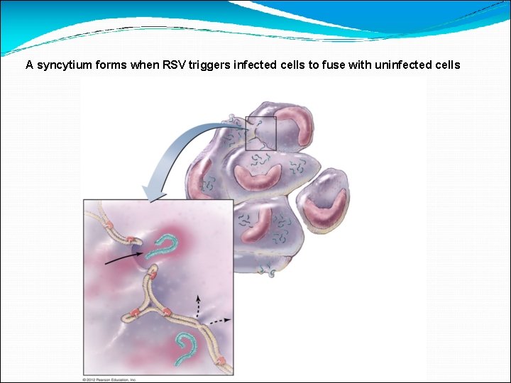 A syncytium forms when RSV triggers infected cells to fuse with uninfected cells 