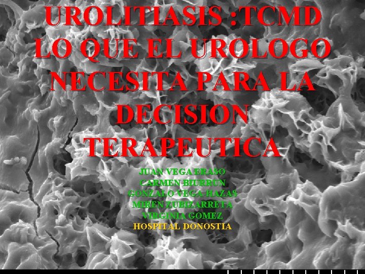 UROLITIASIS : TCMD LO QUE EL UROLOGO NECESITA PARA LA DECISION TERAPEUTICA JUAN VEGA