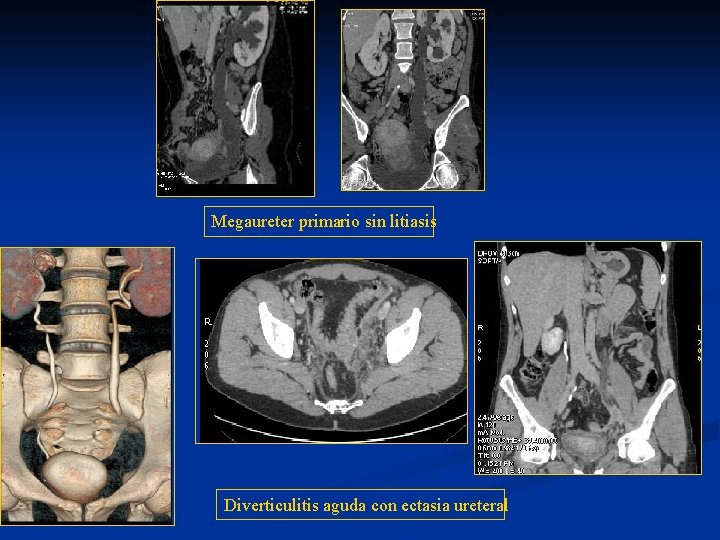 Megaureter primario sin litiasis Diverticulitis aguda con ectasia ureteral 