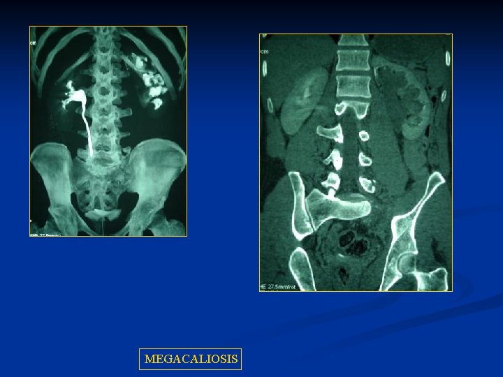 MEGACALIOSIS 