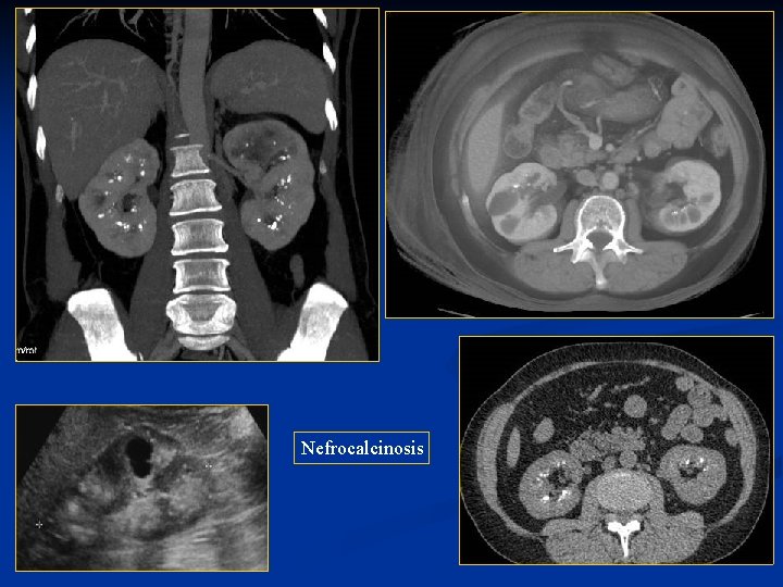 Nefrocalcinosis 