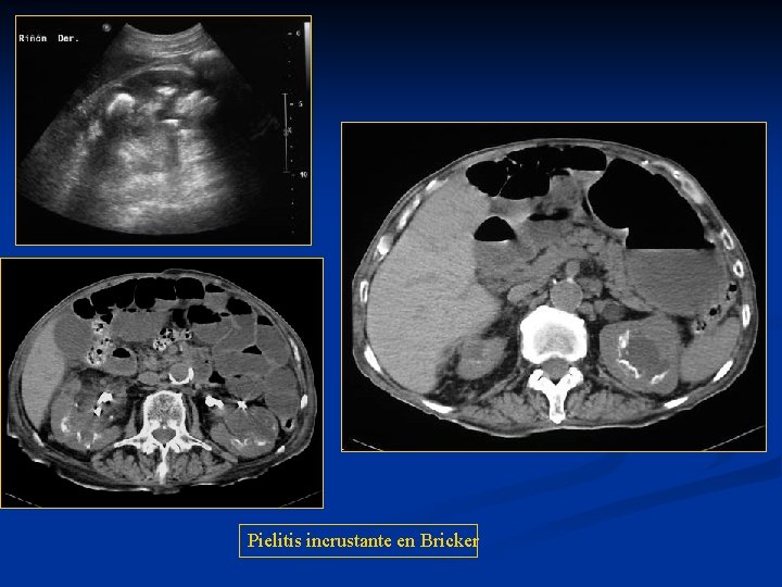 Pielitis incrustante en Bricker 
