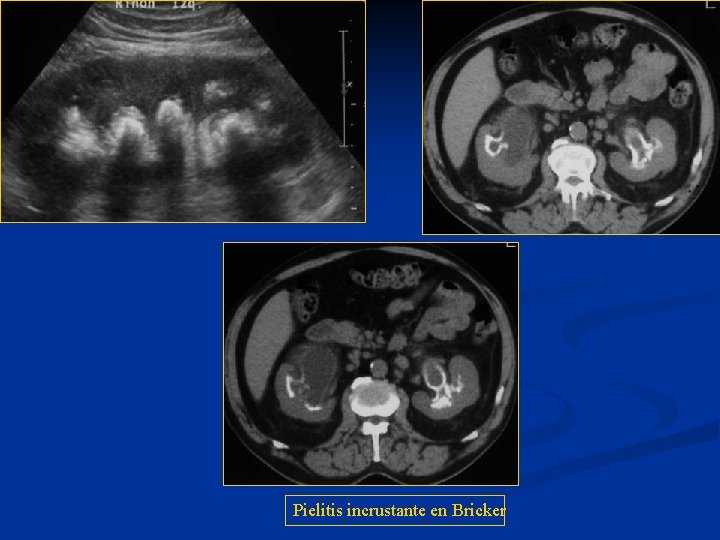 Pielitis incrustante en Bricker 