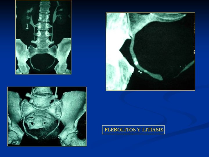 FLEBOLITOS Y LITIASIS 