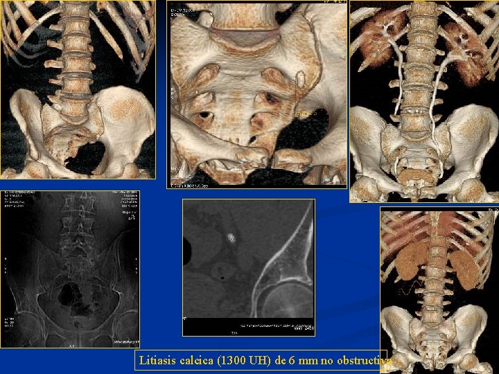 Litiasis calcica (1300 UH) de 6 mm no obstructiva 