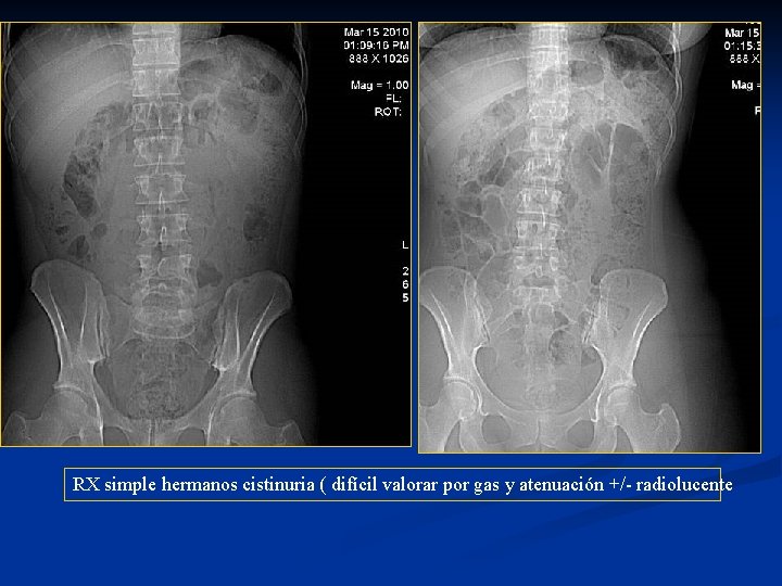 RX simple hermanos cistinuria ( difícil valorar por gas y atenuación +/- radiolucente 