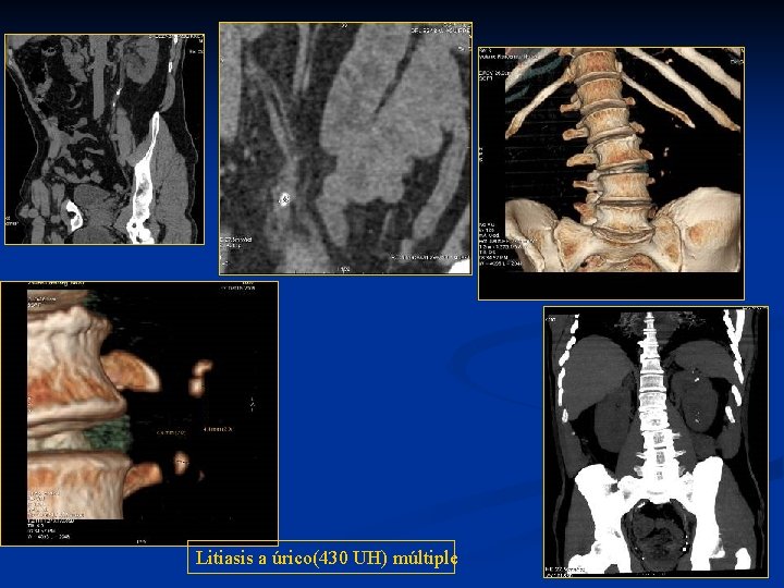 Litiasis a úrico(430 UH) múltiple 