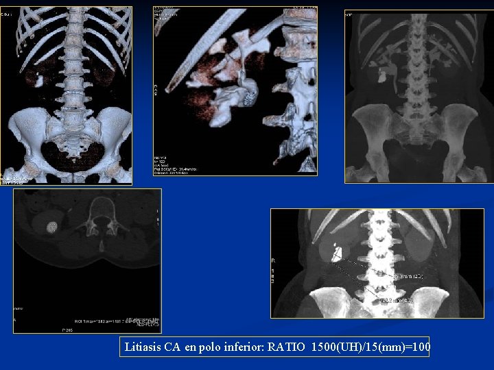 Litiasis CA en polo inferior: RATIO 1500(UH)/15(mm)=100 