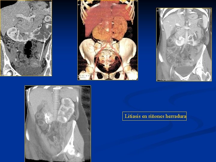 Litiasis en riñones herradura 