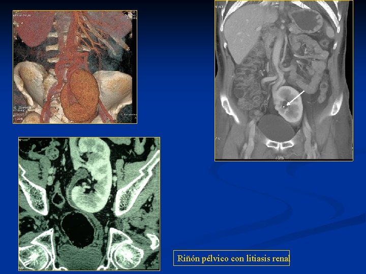 Riñón pélvico con litiasis renal 