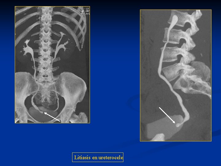 Litiasis en ureterocele 