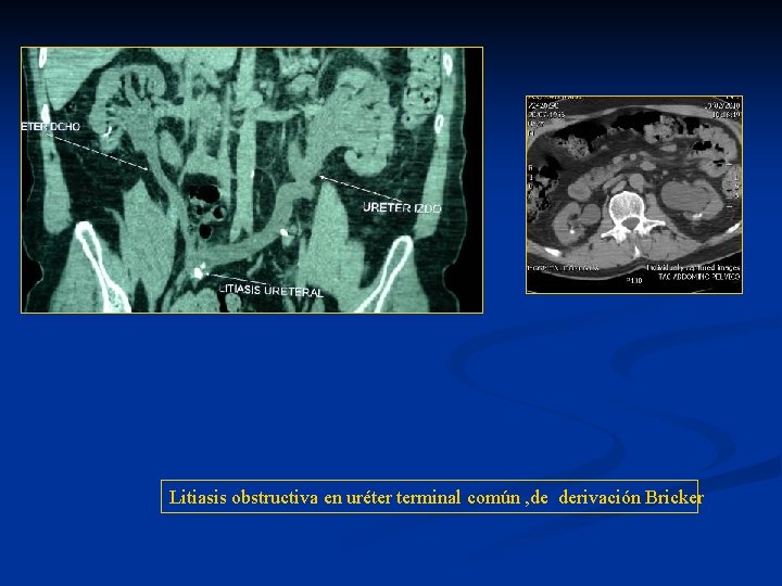 Litiasis obstructiva en uréter terminal común , de derivación Bricker 
