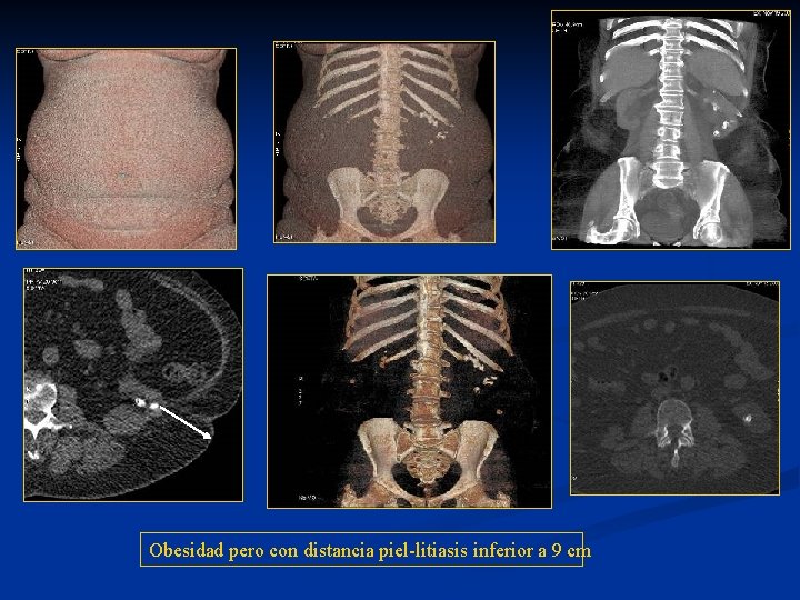 Obesidad pero con distancia piel-litiasis inferior a 9 cm 