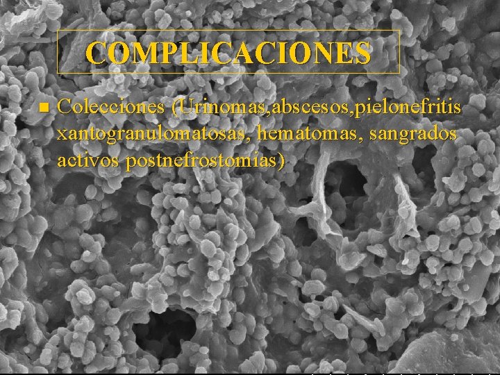 COMPLICACIONES n Colecciones (Urinomas, abscesos, pielonefritis xantogranulomatosas, hematomas, sangrados activos postnefrostomias) 