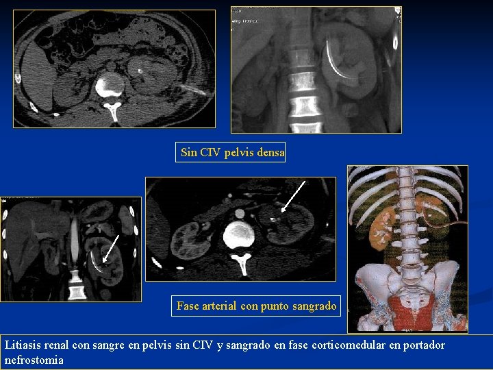 Sin CIV pelvis densa Fase arterial con punto sangrado Litiasis renal con sangre en