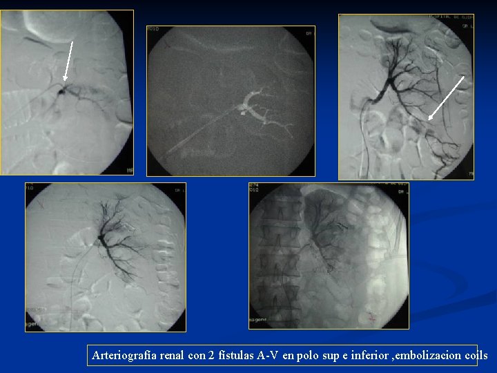 Arteriografía renal con 2 fístulas A-V en polo sup e inferior , embolizacion coils