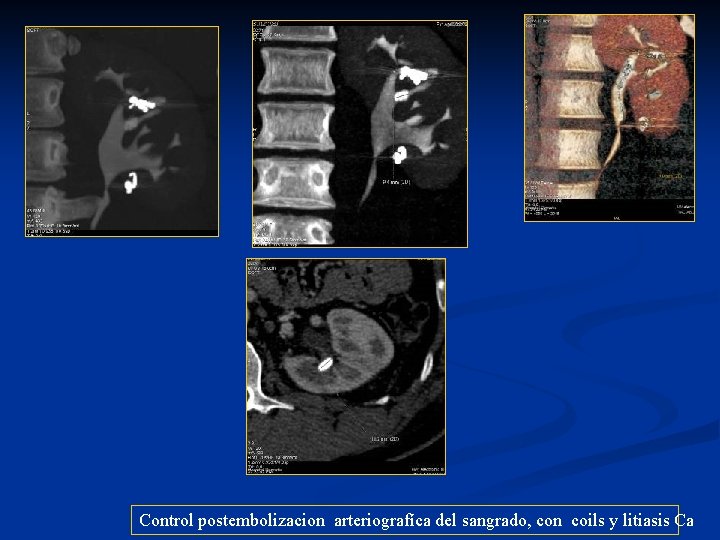 Control postembolizacion arteriografíca del sangrado, con coils y litiasis Ca 