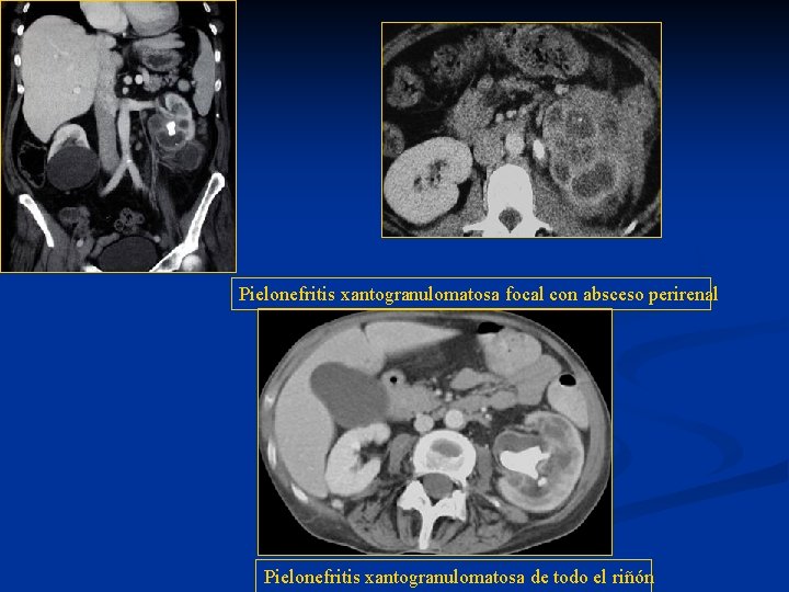 Pielonefritis xantogranulomatosa focal con absceso perirenal Pielonefritis xantogranulomatosa de todo el riñón 