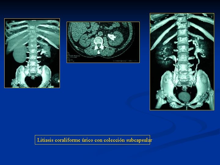 Litiasis coraliforme úrico con colección subcapsular 