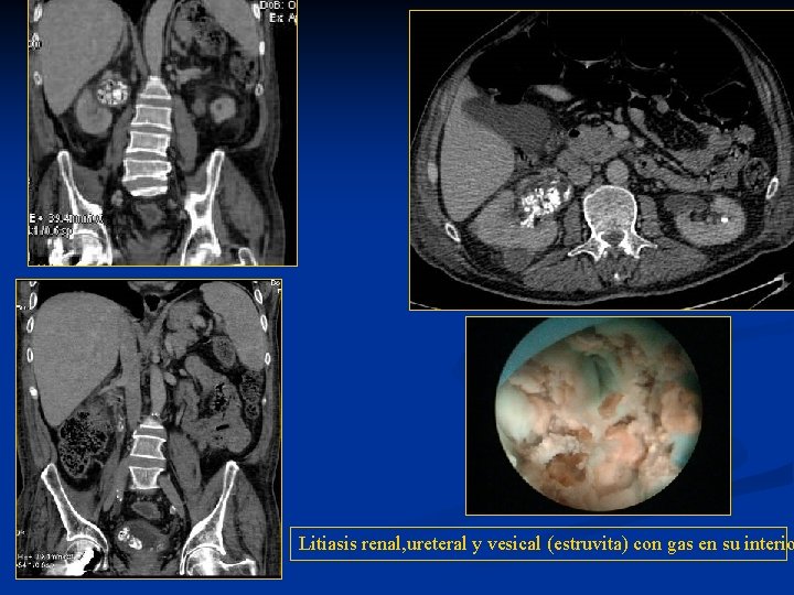 n Litiasis renal, ureteral y vesical (estruvita) con gas en su interio 