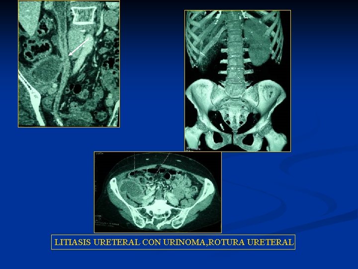 LITIASIS URETERAL CON URINOMA, ROTURA URETERAL 
