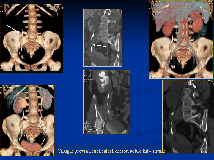 Cirugia previa renal, calcificacion sobre hilo sutura 